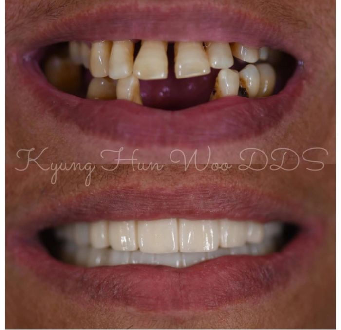 Woo Dental before-and-after smile transformation 1