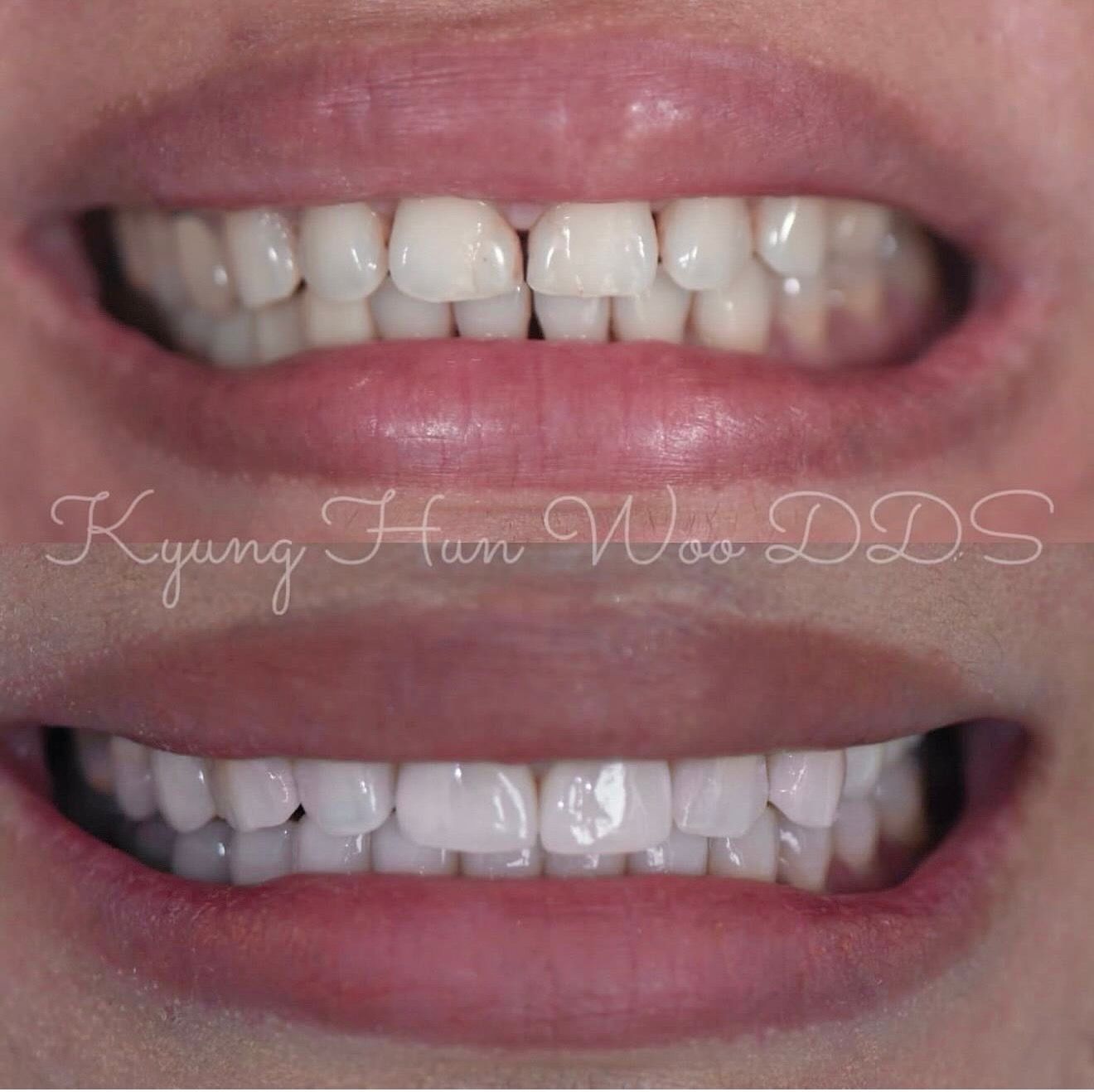 Before and after comparison of a smile, showing initial gapped and uneven teeth at the top, and bright, perfectly aligned teeth at the bottom. Text: Kyung Han Woo DDS.