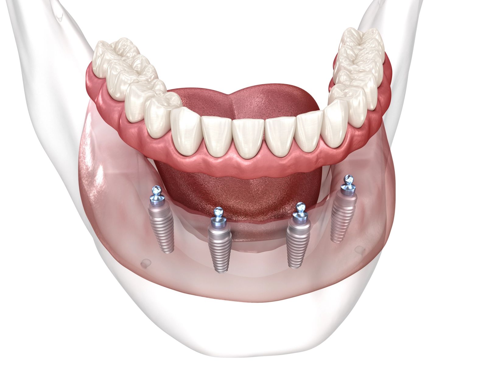 Overdenture