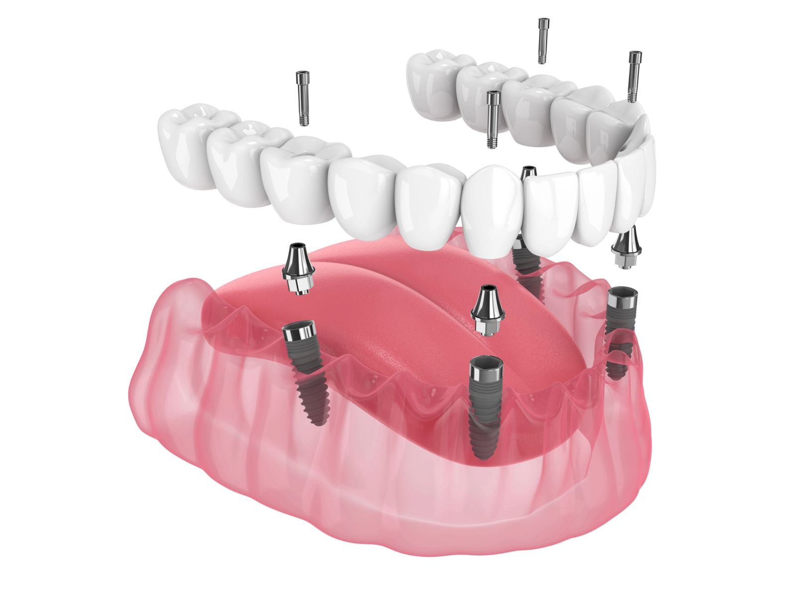 Woo Dental All-on-X care