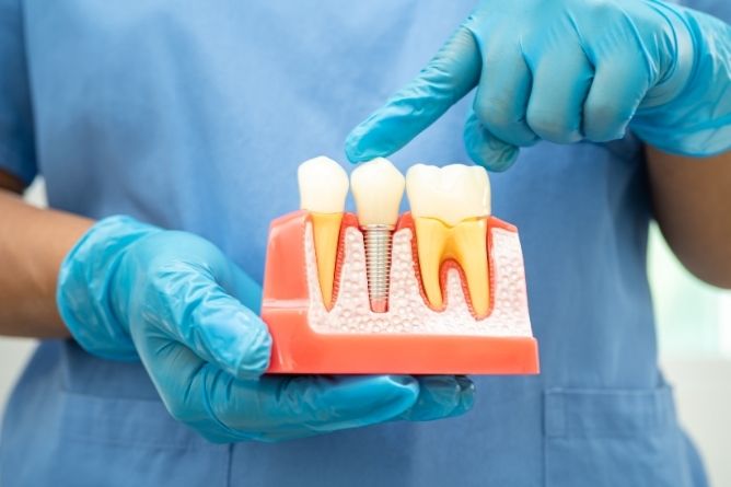 a dentist is holding a model of a dental implant in his hands .