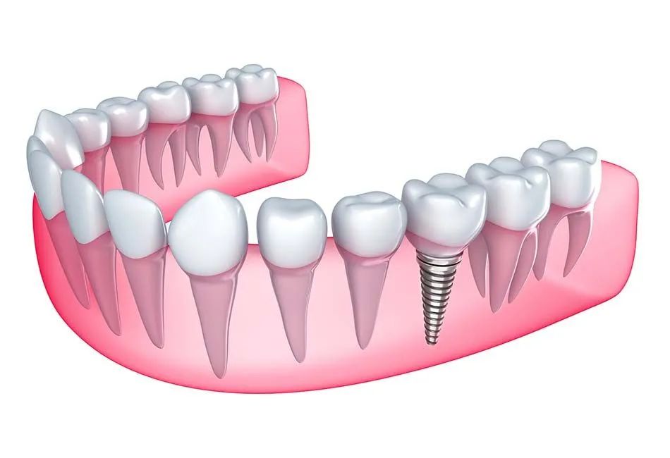 Single Implant