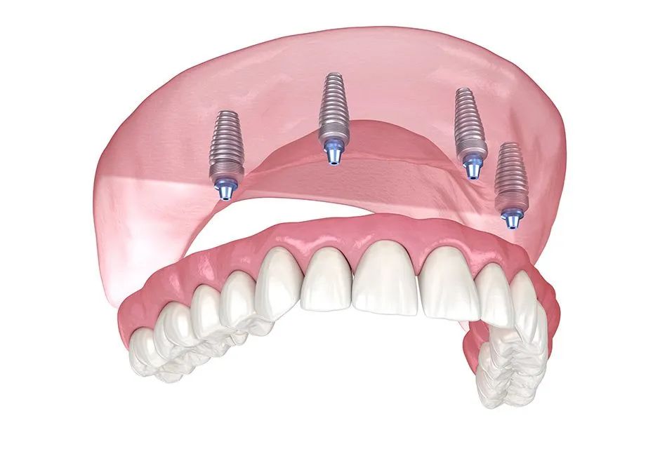 Full-arch dental implant restoration