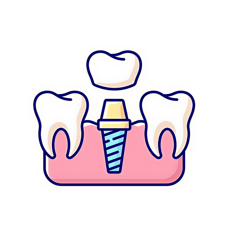 an illustration of a dental implant with a crown on top