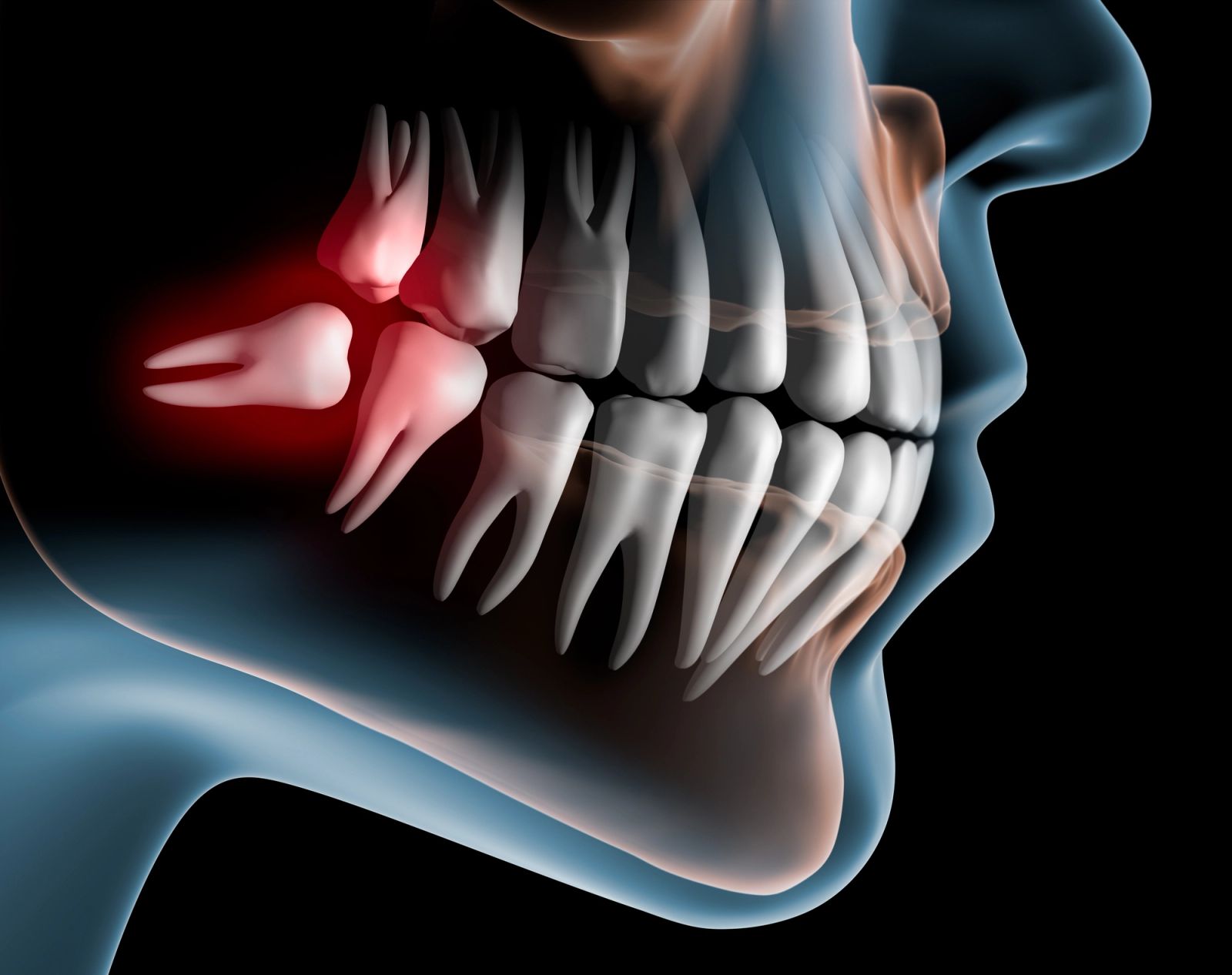 3D render of an impacted wisdom tooth highlighted in red within a translucent jaw.