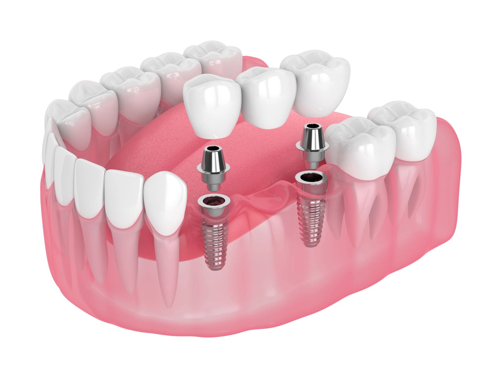Featured image for Implant Bridges at Woo Dental: A Stable Way to Replace Several Missing Teeth