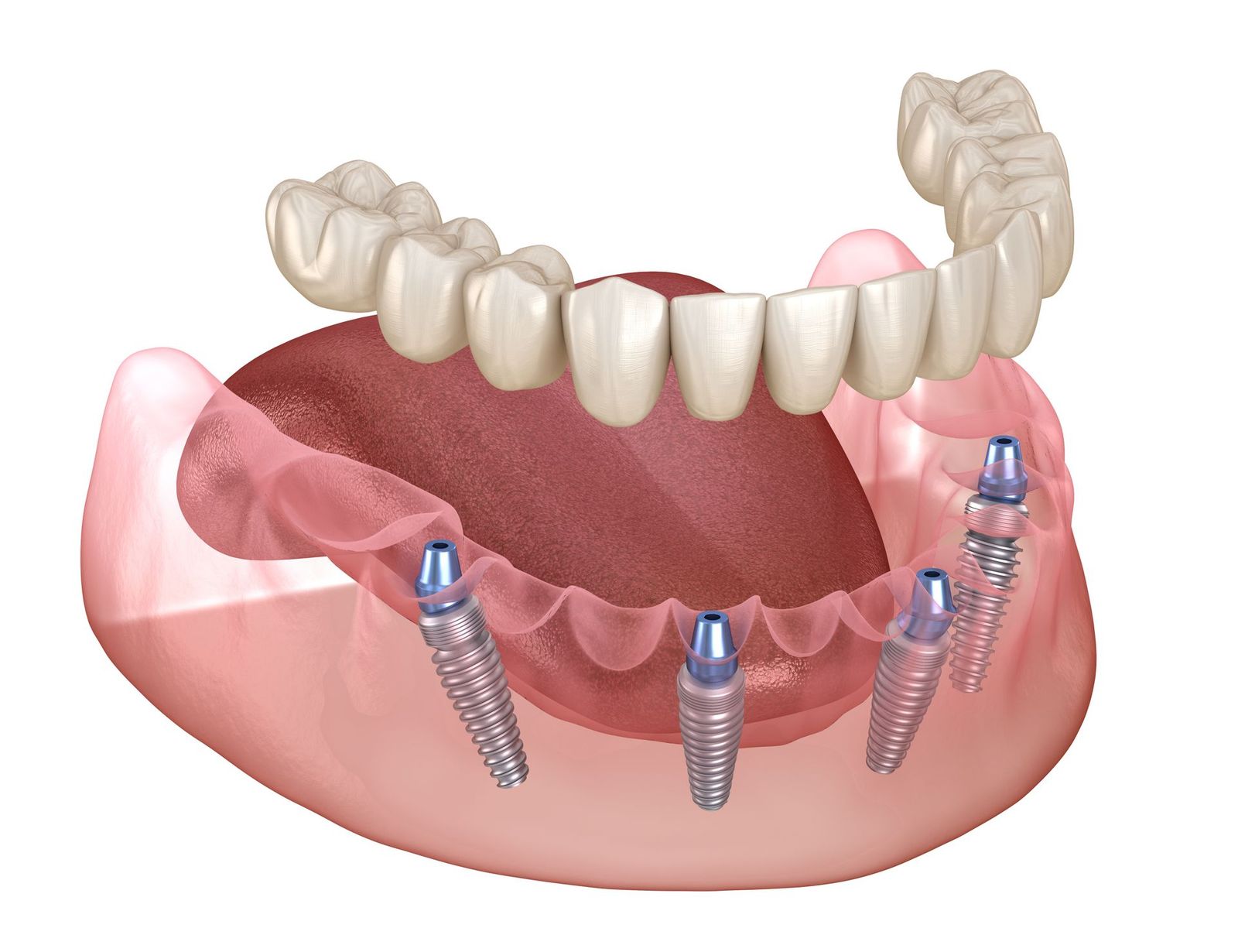 Featured image for Full-Arch Freedom: All-on-X Fixed Implants Explained Clearly