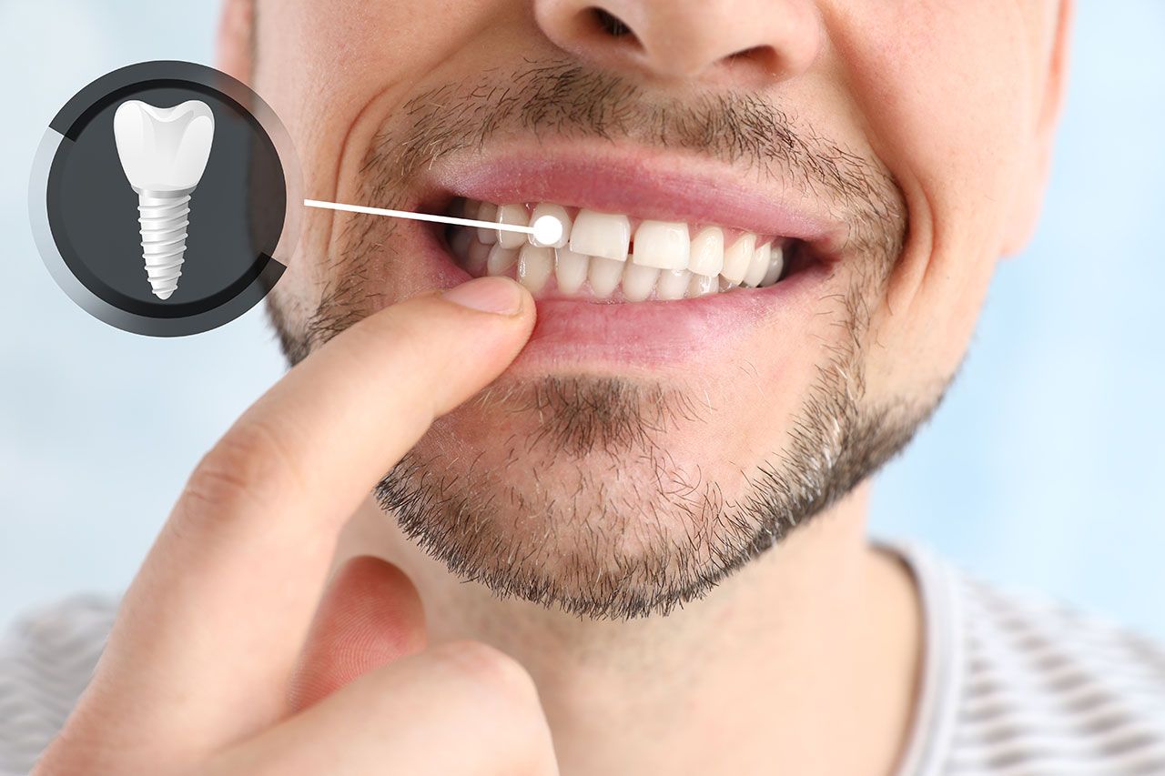 Featured image for Stronger Than Ever: Why Dental Implants Are the Gold Standard for Tooth Replacement