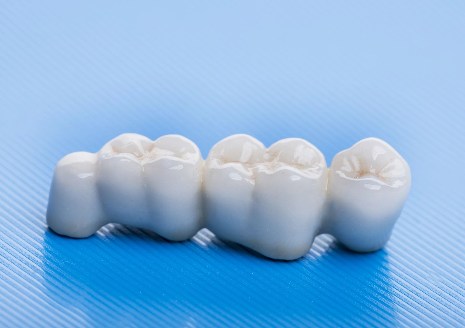 Featured image for Dental Bridges at Woo Dental: Filling the Gap with Strength and Stability