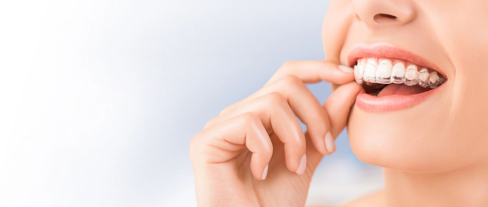 Featured image for Invisalign Clear Aligners: Straighten Your Smile Without the Metal